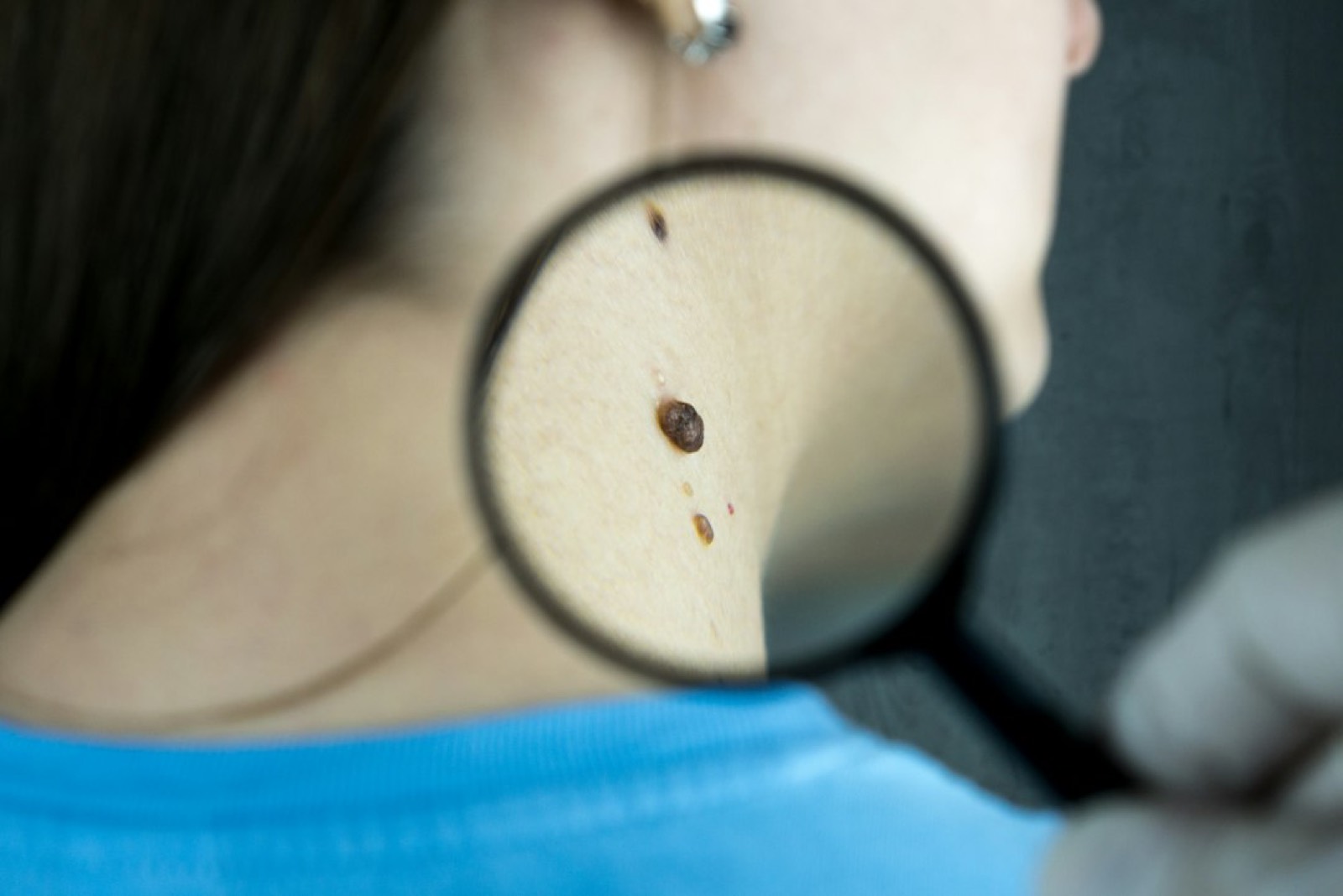 Examen du cuir chevelu de près par un professionnel de santé
